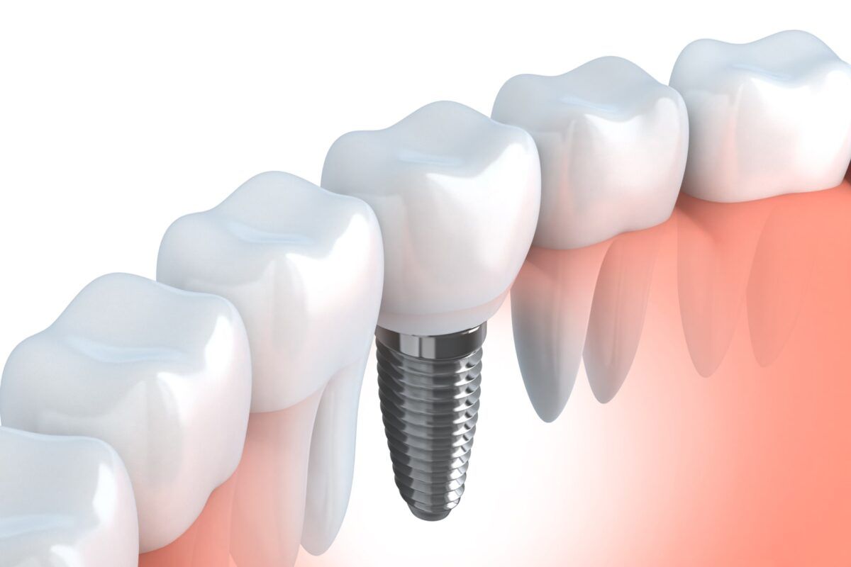 Illustration of Teeth and Dental Implant