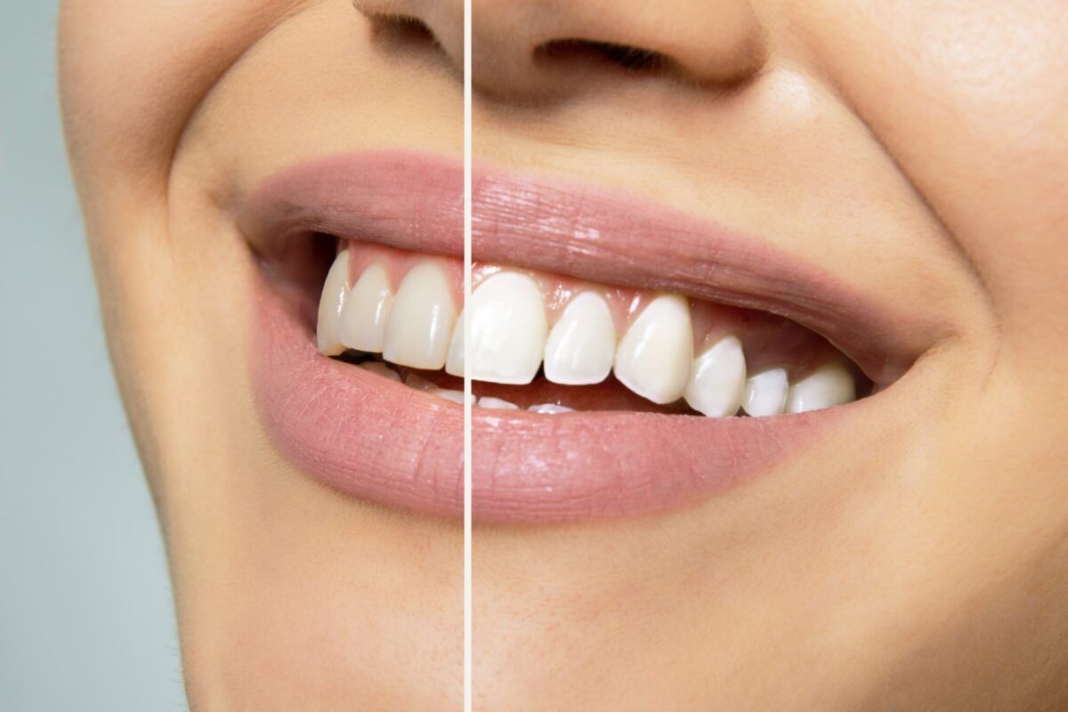 stained vs white teeth split screen
