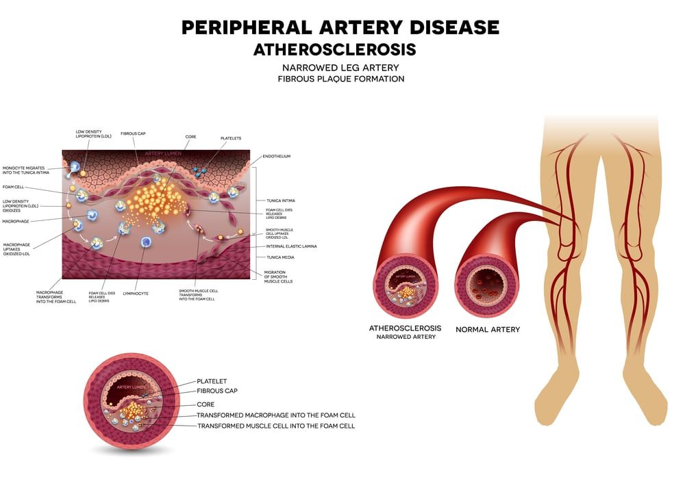 Peripheral Vascular Intervention