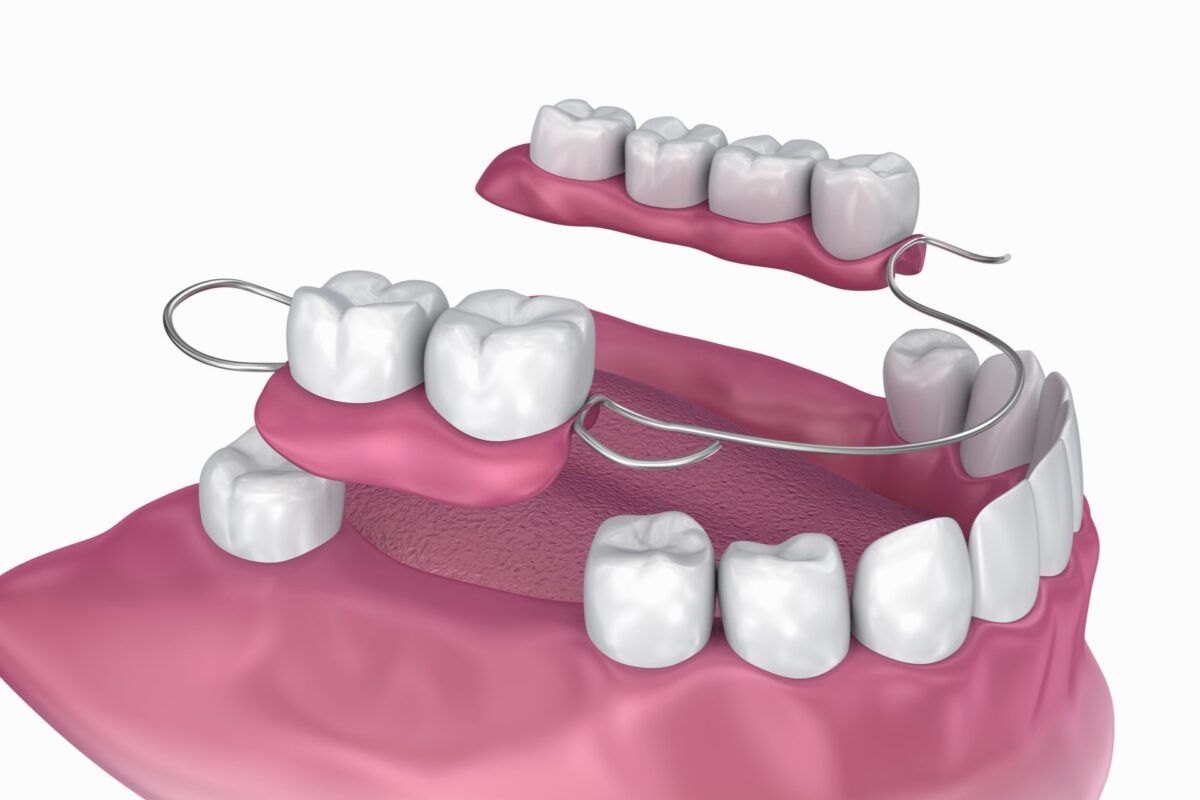Graphic of Partial Denture