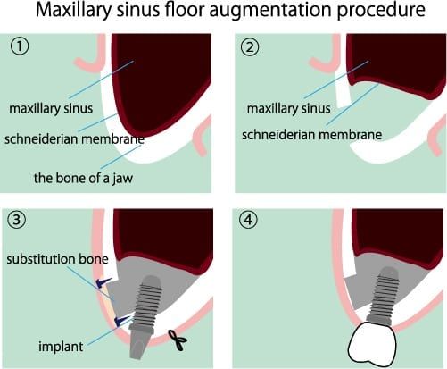 sinus augmentation for dental implants