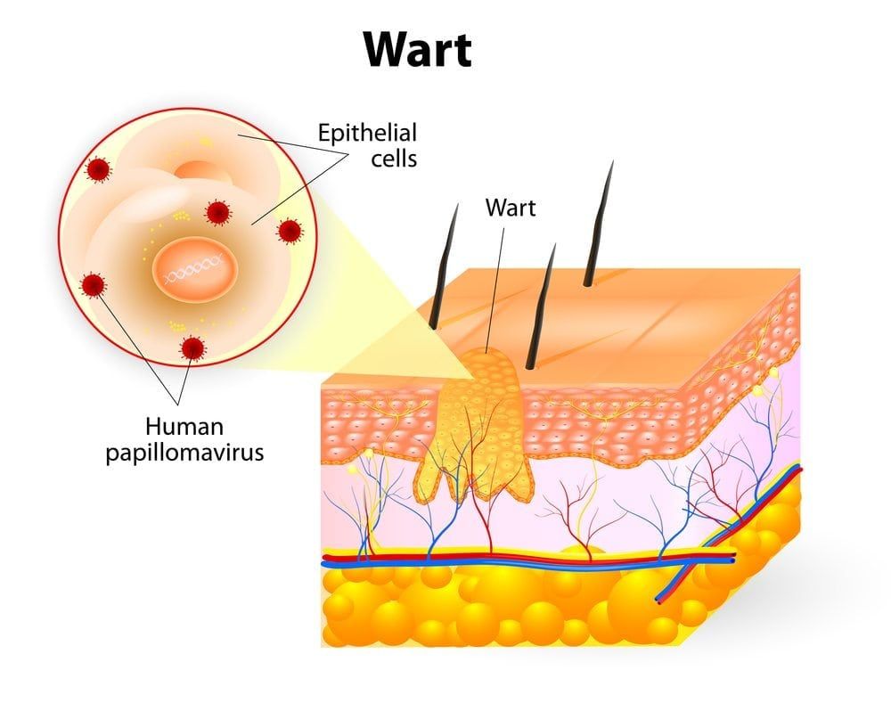 Diagram illustrating layers of the skin and which area a wart occupies