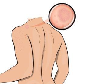 Illustration of a person with Hives on left shoulder