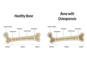 Diagram Illustrating what Osteoporosis is