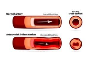 Diagram comparing a normal artery to an enflamed artery