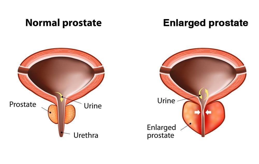 Diagram comparing a normal and enlarged prostate