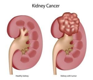 Medical Diagram comparing a healthy kidney to a kidney with a cancerous tumor