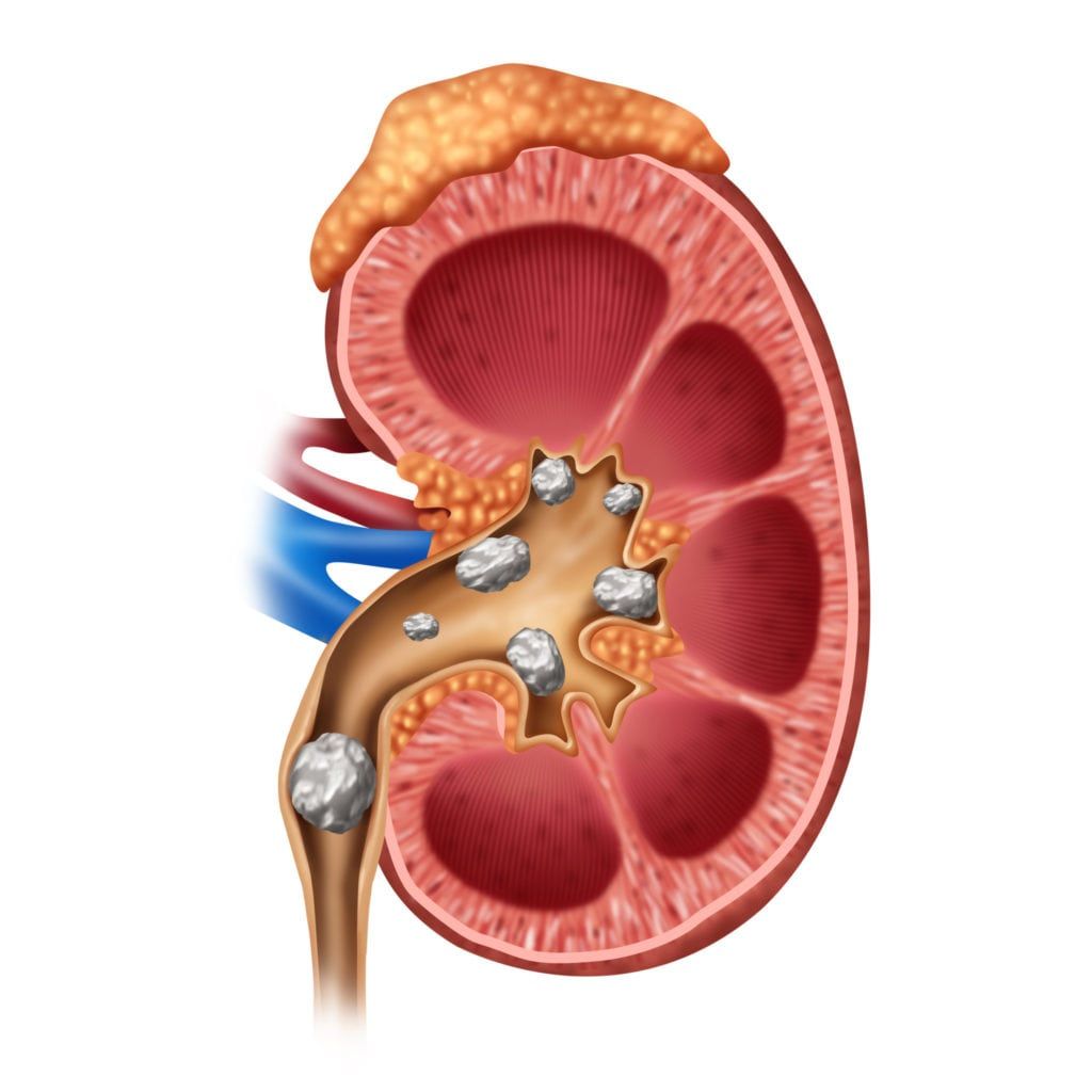 Medical Illustration of a Kidney with stones formed inside the kidney