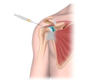 Diagram of injection being administered to rotator cuff