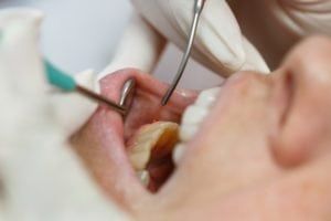 Dentist using tools to work on patients teeth