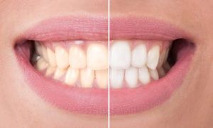 Start Pure teeth whitening