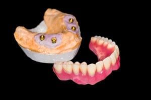dental implant supported denture