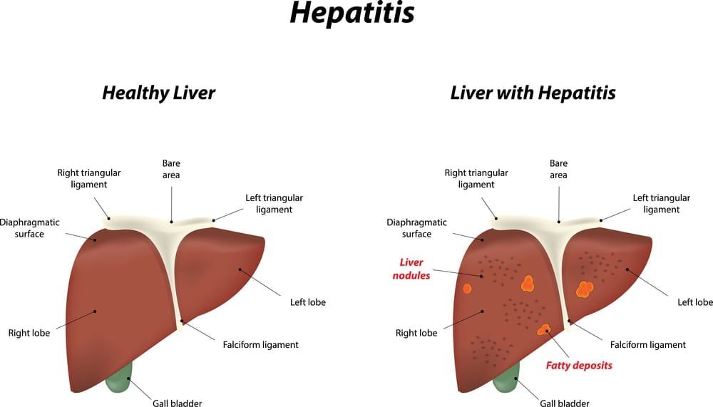 Liver Disease and Hepatitis – O360 Content Library