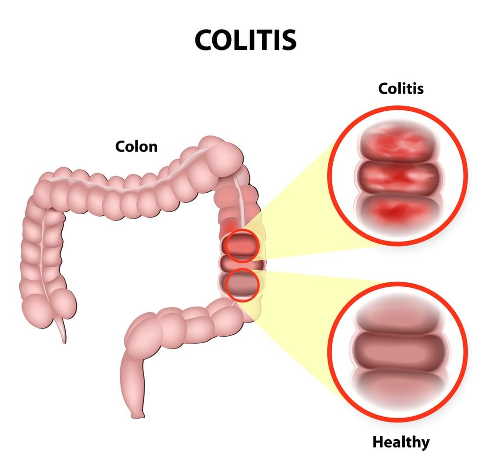 Pediatrics Ulcerative Colitis – O360 Content Library