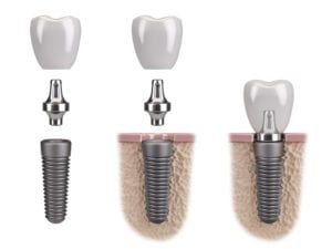 dental implant faq