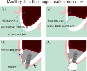 dental implant placement process