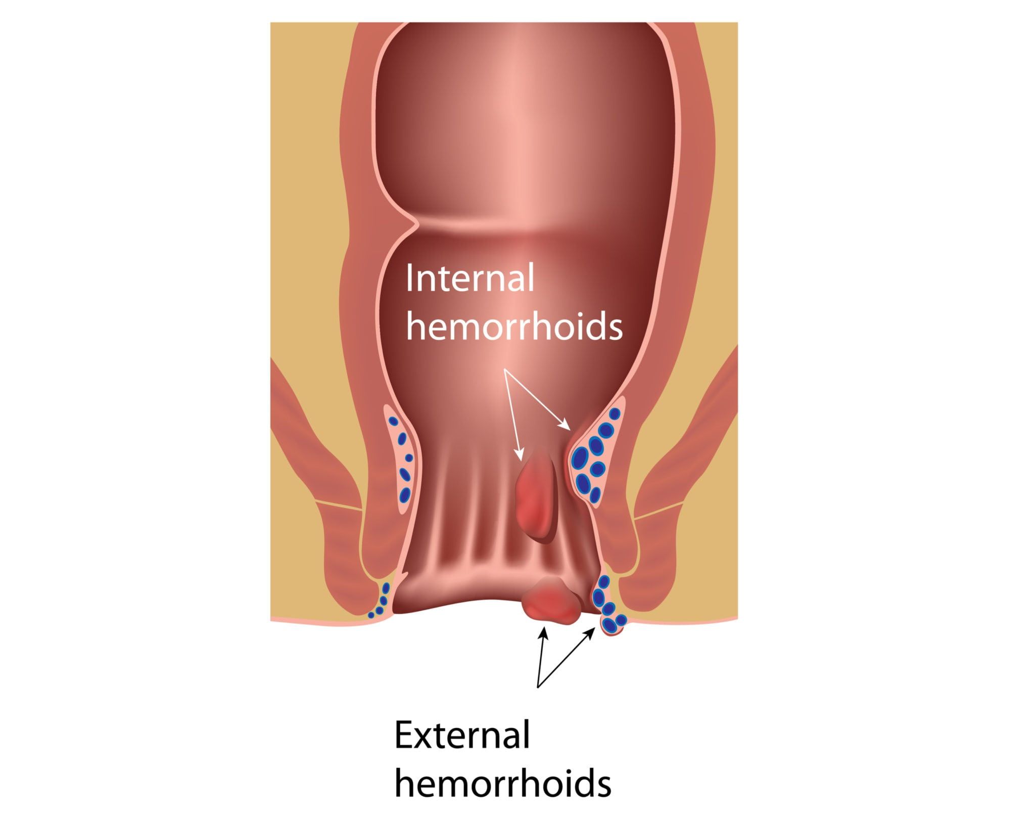Illustrated image of rectum with Hemorrhoids