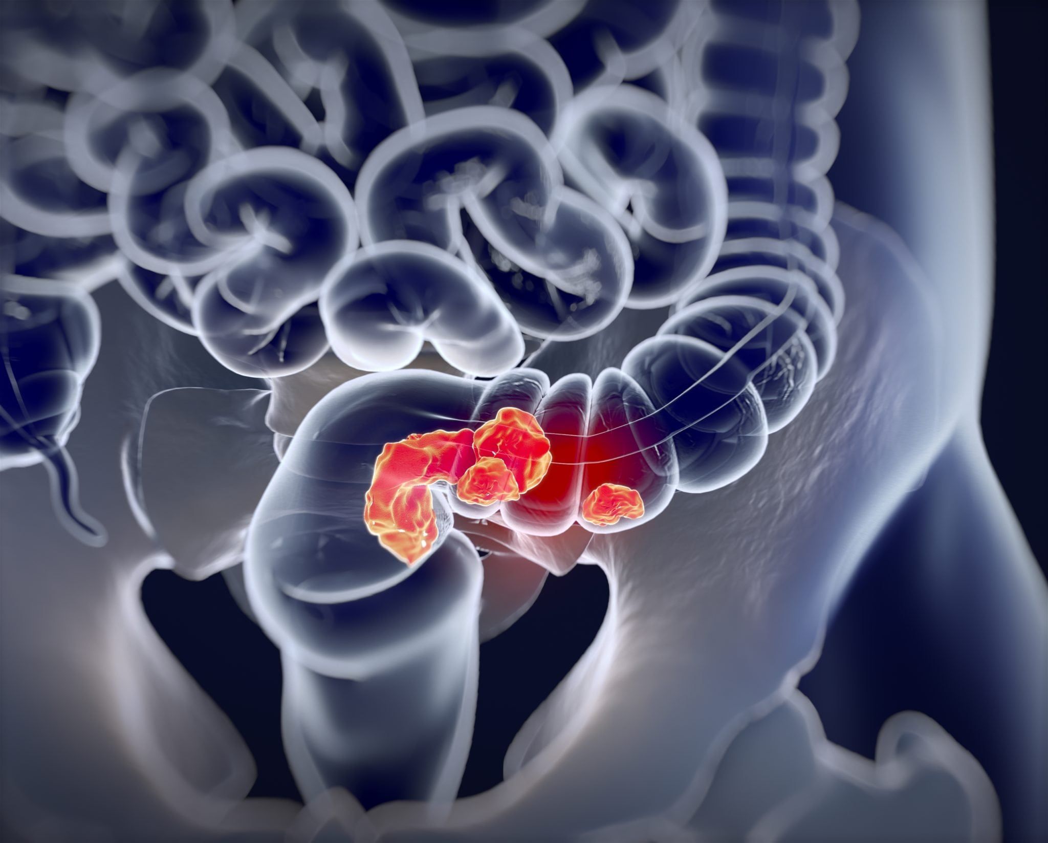 Colorectal cancer, medical anatomical illustration showing early stages of colorectal cancer